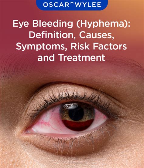 blood leaking from eye|Eye bleeding: Types, causes, treatment, and seeking。